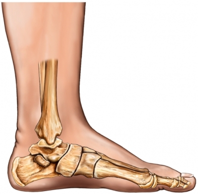 Adult Acquired Flat Feet