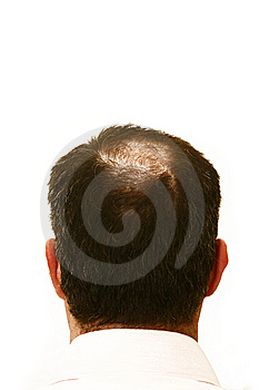  Alopecia on Alopecia Areata Causes Etiology