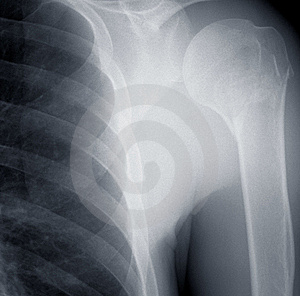 Shoulder x ray mercedes benz