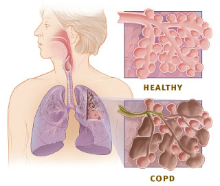Chronic bronchitis alters the pattern of aerosol deposition in the