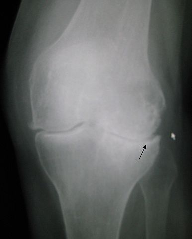 OSTEOARTHRITIS