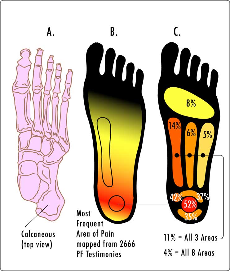 22. HOW TO USE A TENS UNIT WITH FOOT PAIN (TOP, HEEL, PLANTAR FASCIITIS)  CORRECT PAD PLACEMENT