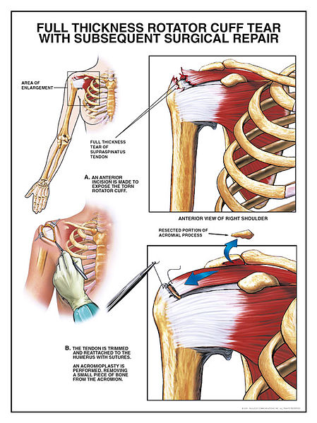 Can physiotherapists help with a Rotator Cuff Tear? — Mainway Physiotherapy