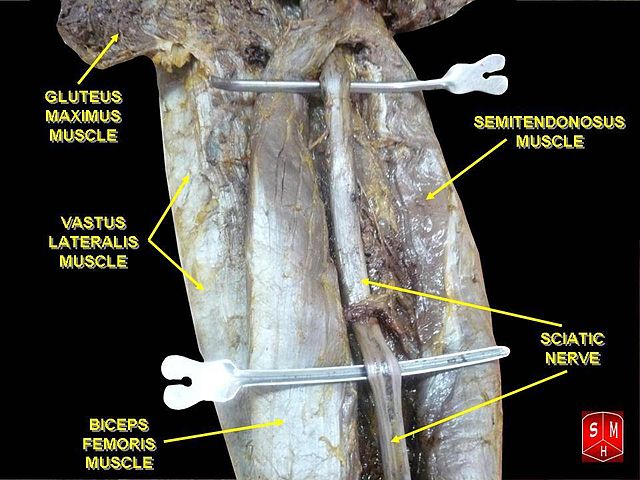 Exercise for sciatica