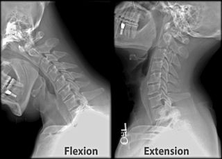 cervical vertigo ray