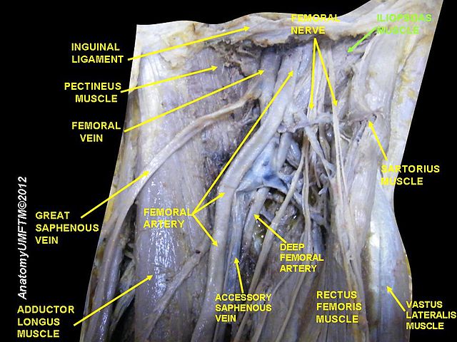 Iliopectineal Bursitis