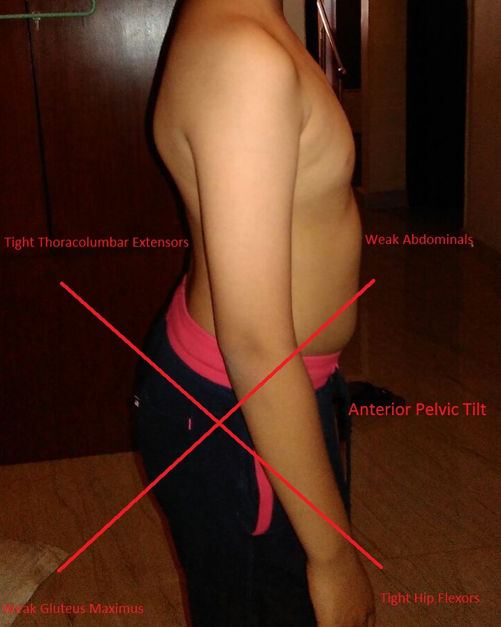 lower cross syndrome