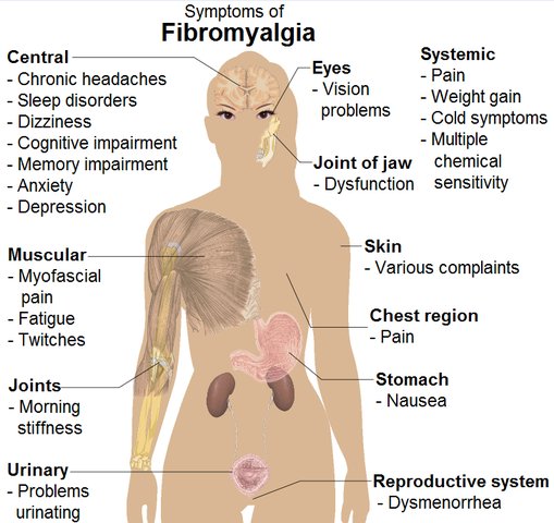 Managing Fibromyalgia an urban ache