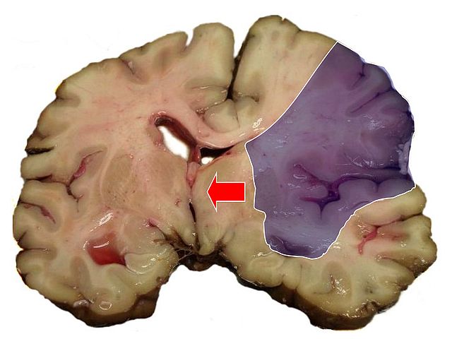 SPASTICITY