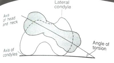  femoral anteversion