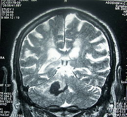 Head MRI Stroke